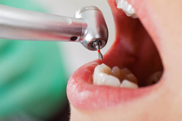 Best Pediatric Emergency Dentist in Burlington, CO
